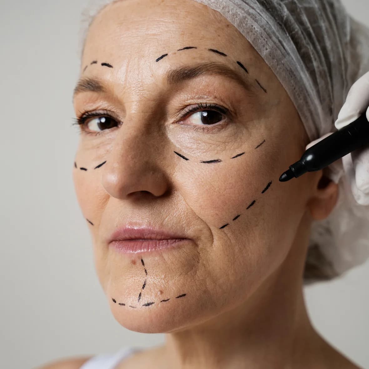 Skin Rejuvenation - Before