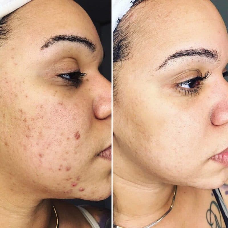 Scar Reduction Before & After result 2