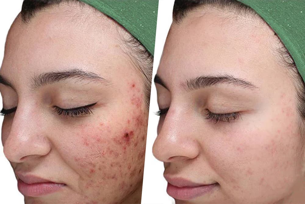 Chemical Peels Before & After result 3