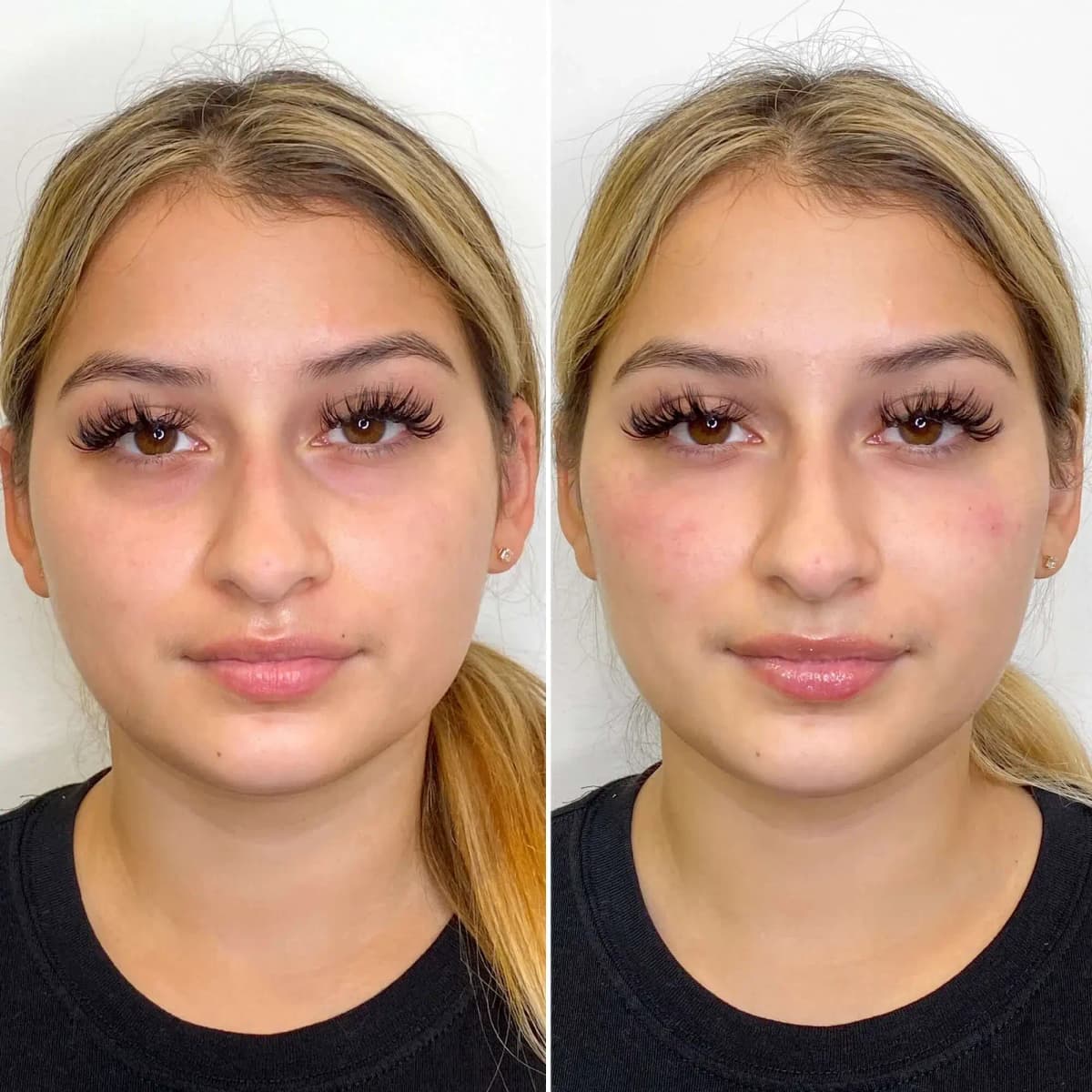 Dermal Fillers Before & After result 4