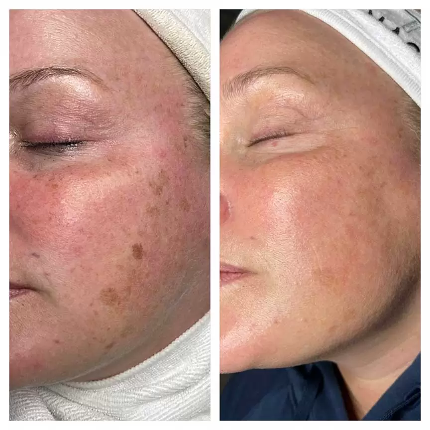 Scar Reduction treatment 4