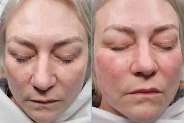 HydraFacial Before & After result 6