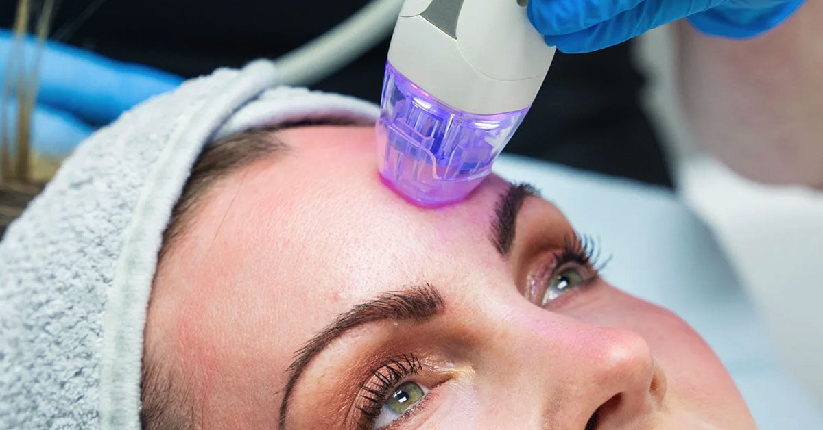 RF Microneedling in Renton, WA for Acne Scars and Tightening - Rani Beauty Clinic