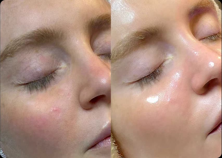 HydraFacial MD treatment at Rani Beauty Clinic Renton