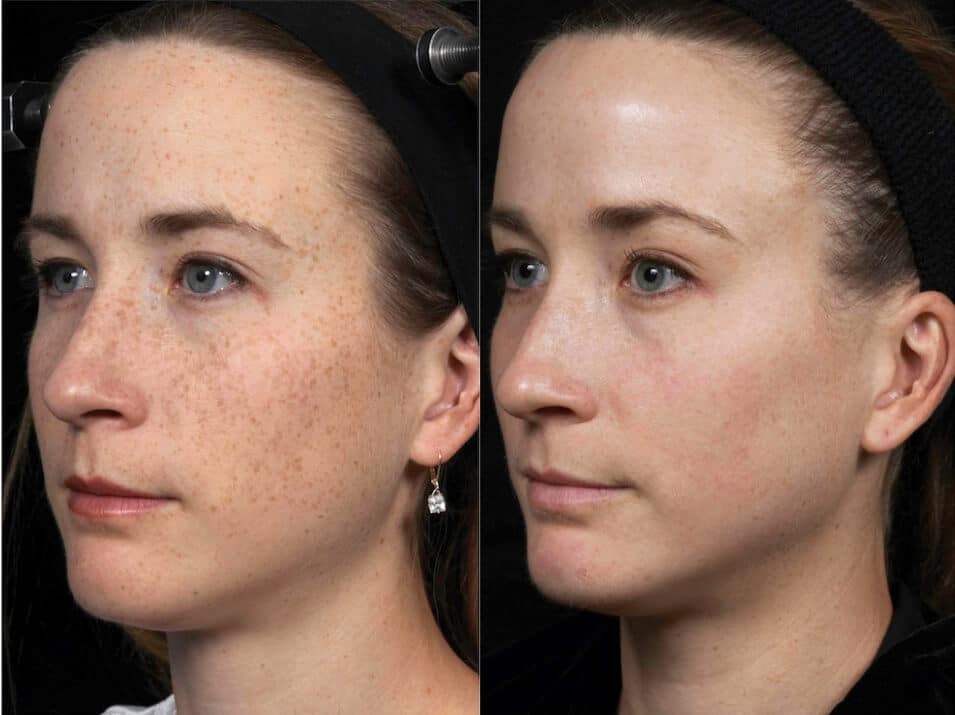 AI Skin Analysis at Rani Beauty Clinic