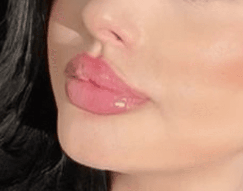 Laser Hair Removal Before & After result 9