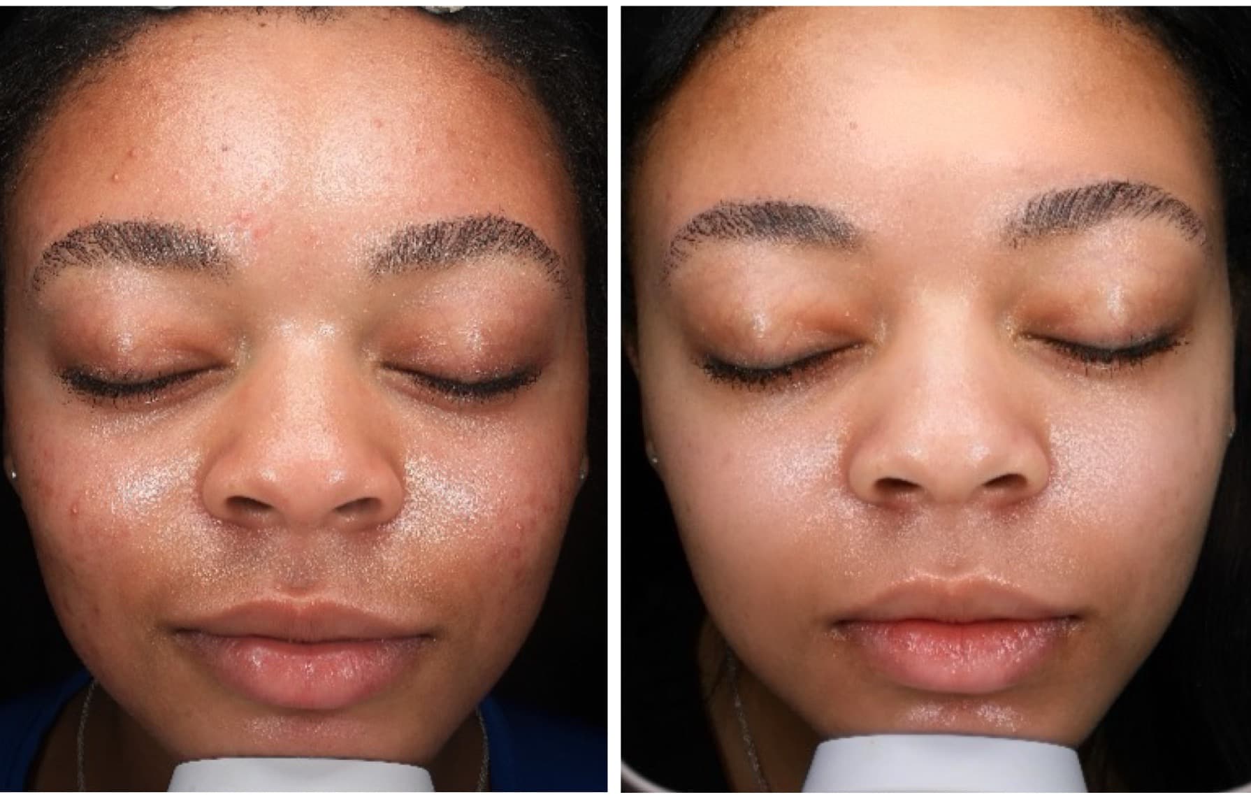 HydraFacial treatment 4